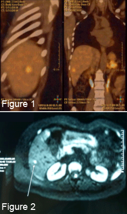 Métastase unique hépatique d'un cancer médullaire de la thyroïde