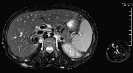 IRM du 5 octobre 2009 : phéochromocytome droit de 28 mm de diamètre.