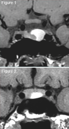 Figure : Une scintigraphie thyroïdienne indiquée dans l'exploration d'une hypothyroïdie ! 