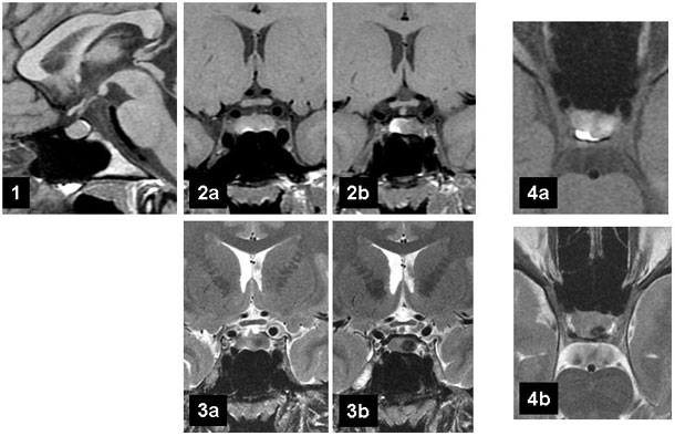 Microprolactinome, quand les coupes axiales font le diagnostic...