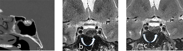 Microprolactinome, quand les coupes axiales font le diagnostic...