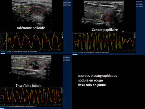 Élastographie relative quantifiée : nodule bénin, cancer papillaire et foyer de thyroïdite. 