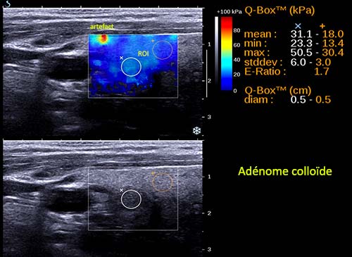 Ondes de cisaillement – Aixplorer : adénome colloïde. Indice de rigidité faible.