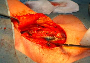Vue opératoire du ganglion marqué au charbon colloïdal (au-dessus de l’extrémité du ciseau de dissection)