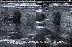 Coupes longitudinale et transversale d'un nodule solide et hypoéchogène dont la forme est irrégulière : plus épais que long et plus épais que large. Les contours sont irréguliers, lobulés, voire anguleux. Score TI-RADS 4B