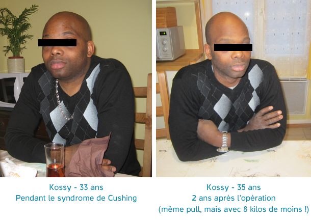 Kossy avant et après le syndrome de Cushing