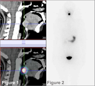 Figure : Une scintigraphie thyroïdienne indiquée dans l'exploration d'une hypothyroïdie ! 