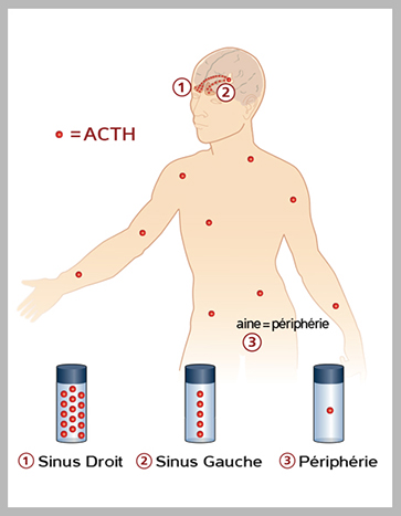 ACTH maladie de cushing