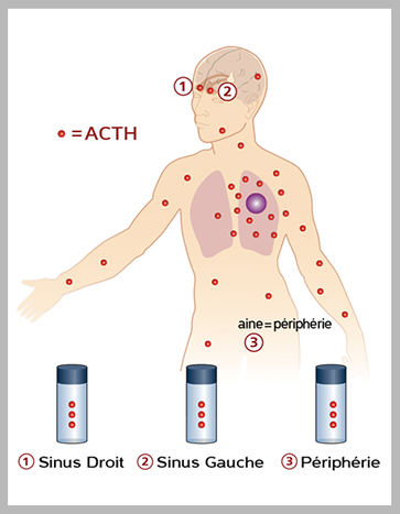ACTH tumeur pulmonaire