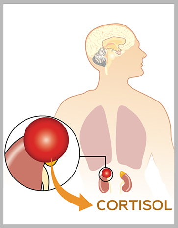 Corticosurrénalome ou cancer surrénalien