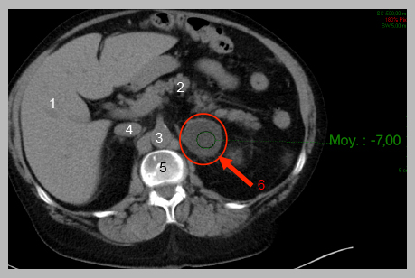 Examen scanner TDM - scanner tomodensimetrie,examen TDM | Cushing ...