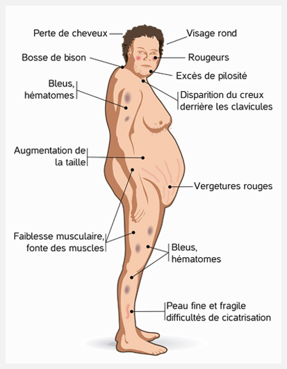 Schéma des problèmes physiques de la maladie de Cushing