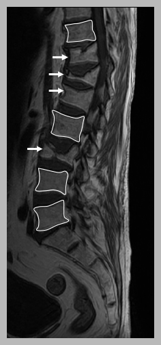 radio d'une fracture 